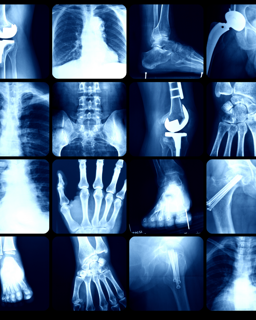 Working in the Operating Room with X-ray – Why Ordinary Gloves Are Not Enough?
